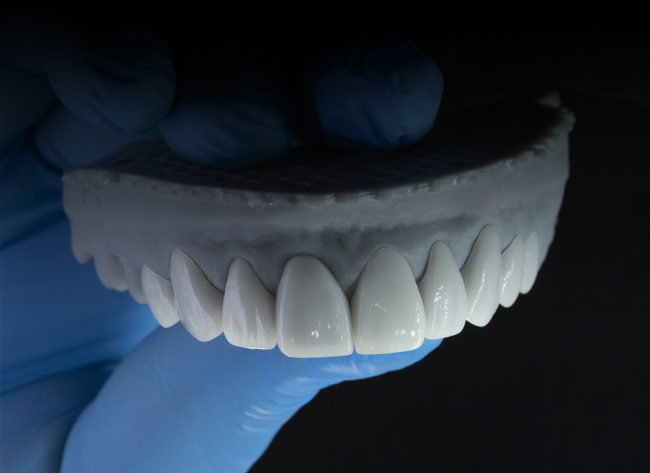 carillas-disilicato-de-litio-4